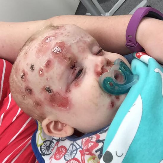 Mom's Plea to Anti-Vaxxers After Baby Gets Chicken Pox