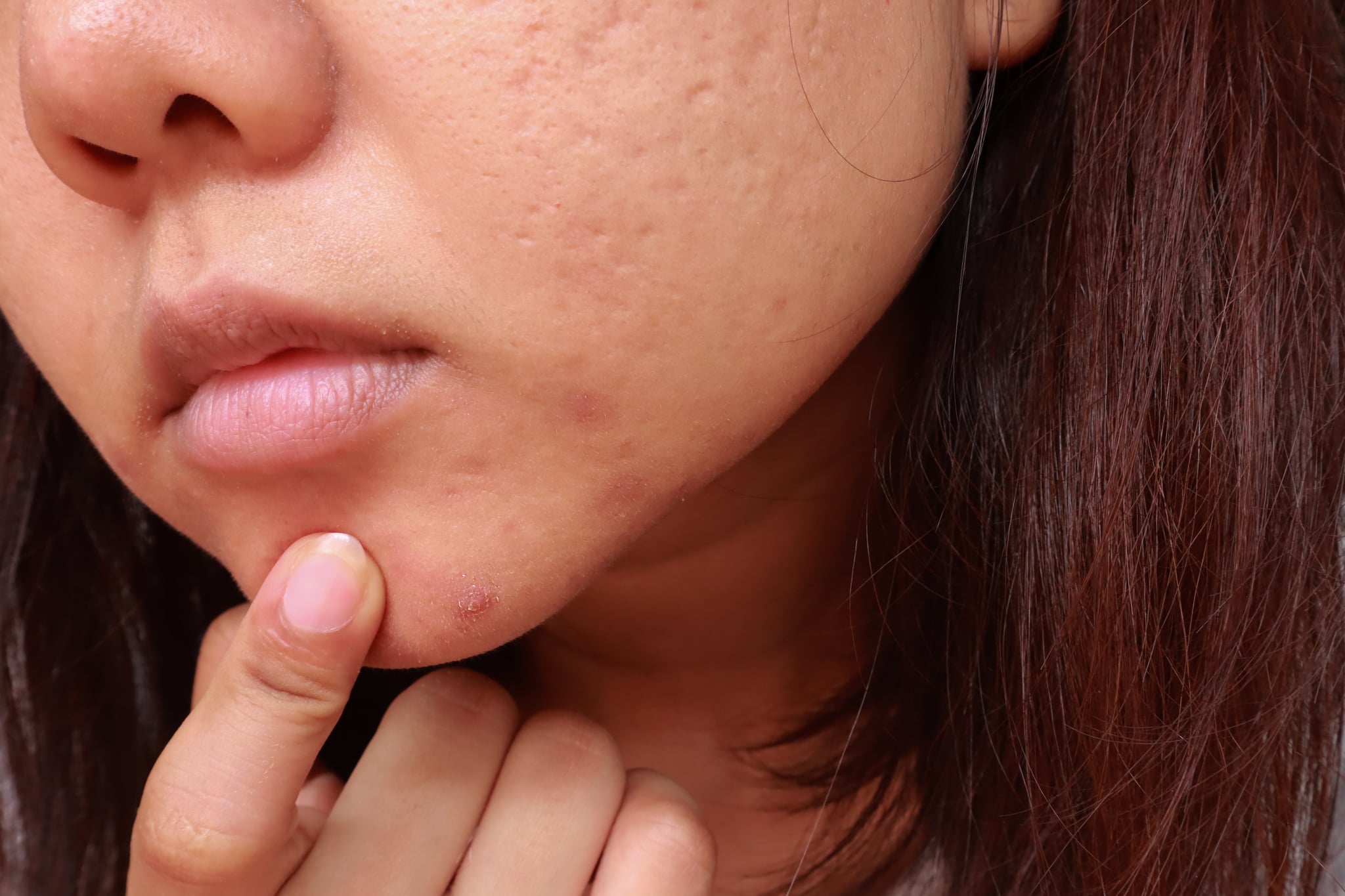 What To Know About Treating Cystic Acne Per Dermatologists Popsugar 