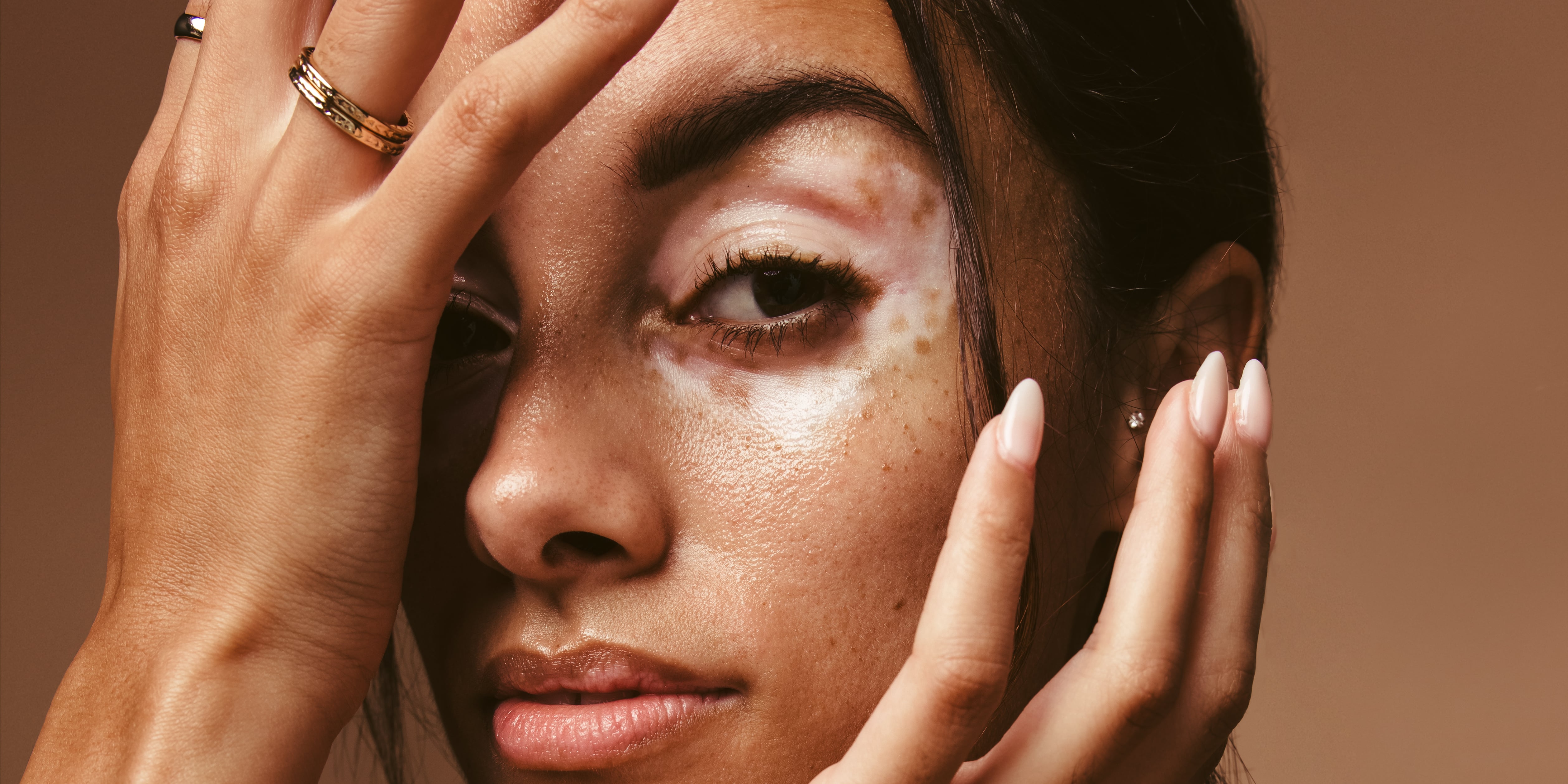 What Is Hypopigmentation? POPSUGAR Beauty