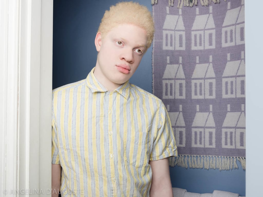 Albinism Photographs