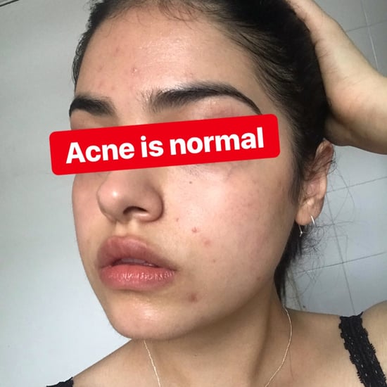 How One Woman's Acne Journey Made Her Discover Self-Love