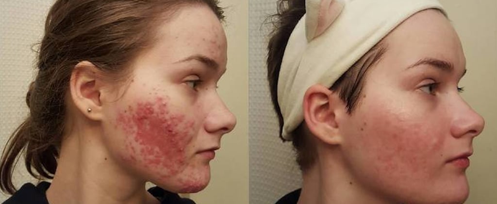 Does Accutane Work?