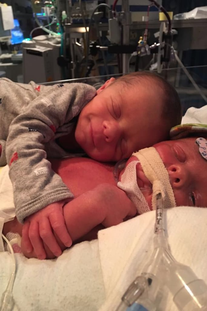The twins who were hugging before one died