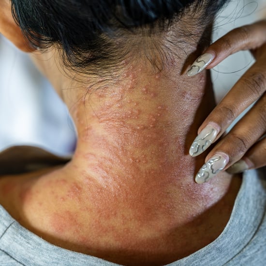 What Is Eczema and How Can You Treat it?