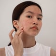 Acne Flaring Up? Here's What to Know About Treating Stress Pimples