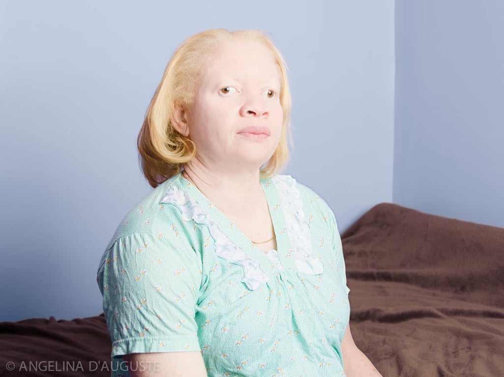 Albinism Photographs