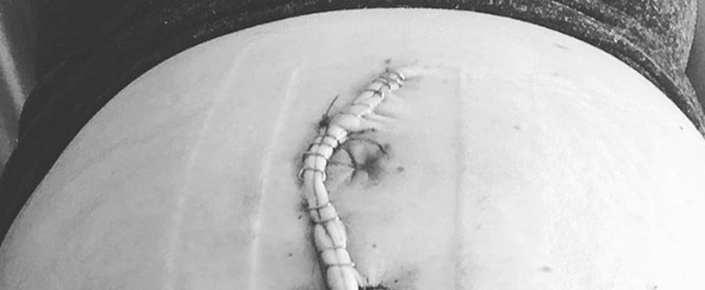 Why You Shouldn't Judge Moms Who Had C-Sections