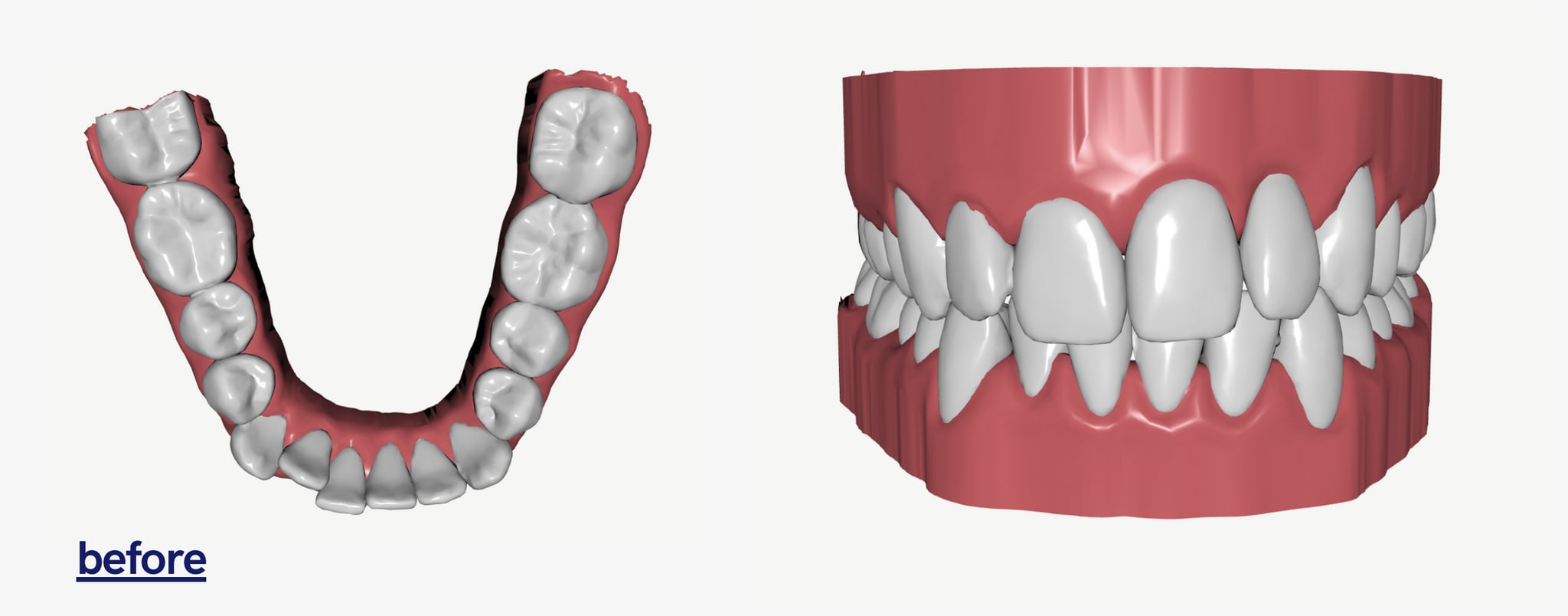 byte teeth impression kit