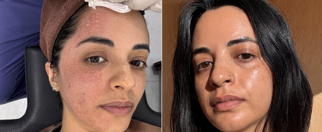 I Tried a Rejuran Salmon Sperm Facial: Review
