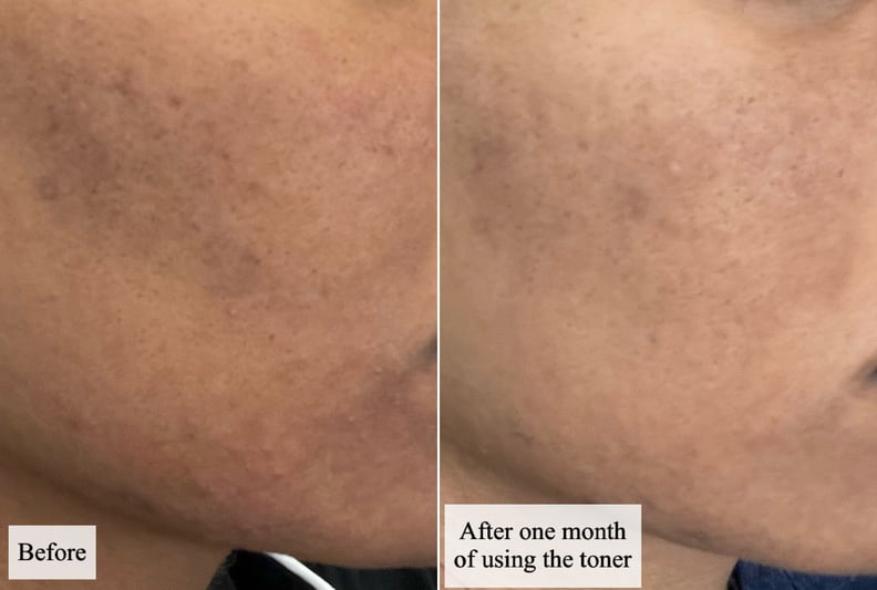 Results using the Eadem Cashmere Peel Gentle Exfoliating AHA Toner for one month.