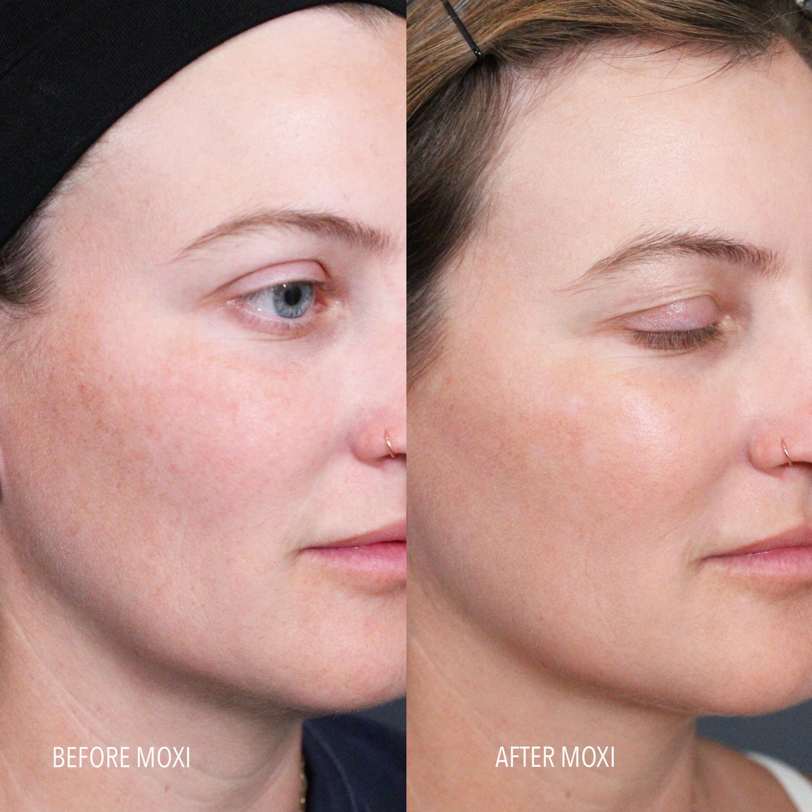 I Tried the Moxi Laser Treatment See Photos POPSUGAR Beauty