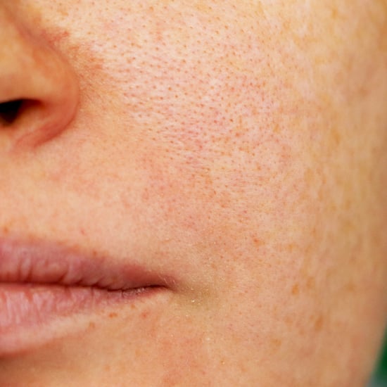 Melasma Treatment and Causes From Doctors