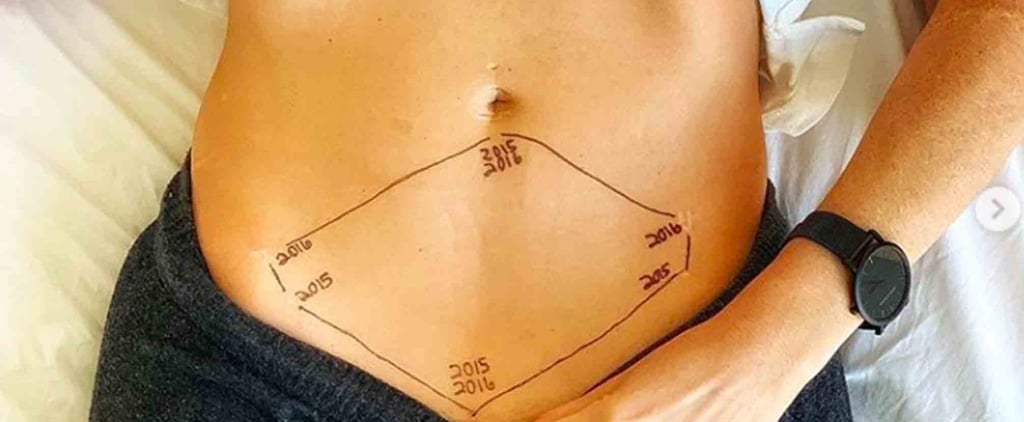 Photo Series on Endometriosis