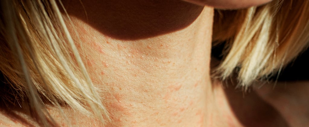 Atopic Dermatitis vs. Eczema: Dermatologists Explain