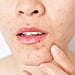 What Is Perioral Dermatitis? 2 Dermatologists Explain the Skin Condition