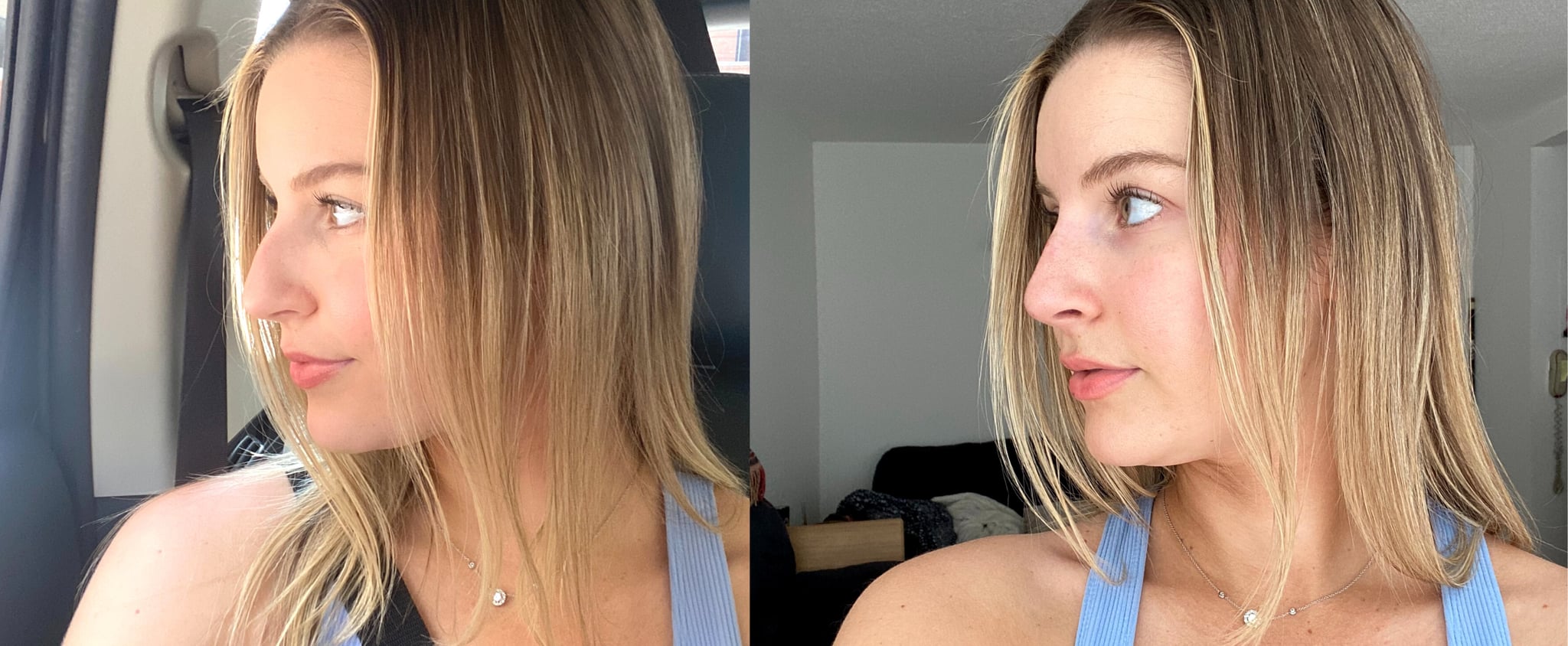 What To Know Before Getting A Liquid Nose Job Popsugar Beauty