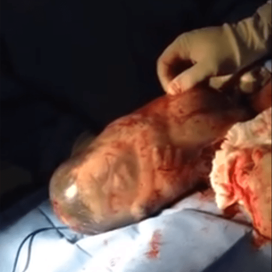 Video of Baby Born En Caul in Amniotic Sac