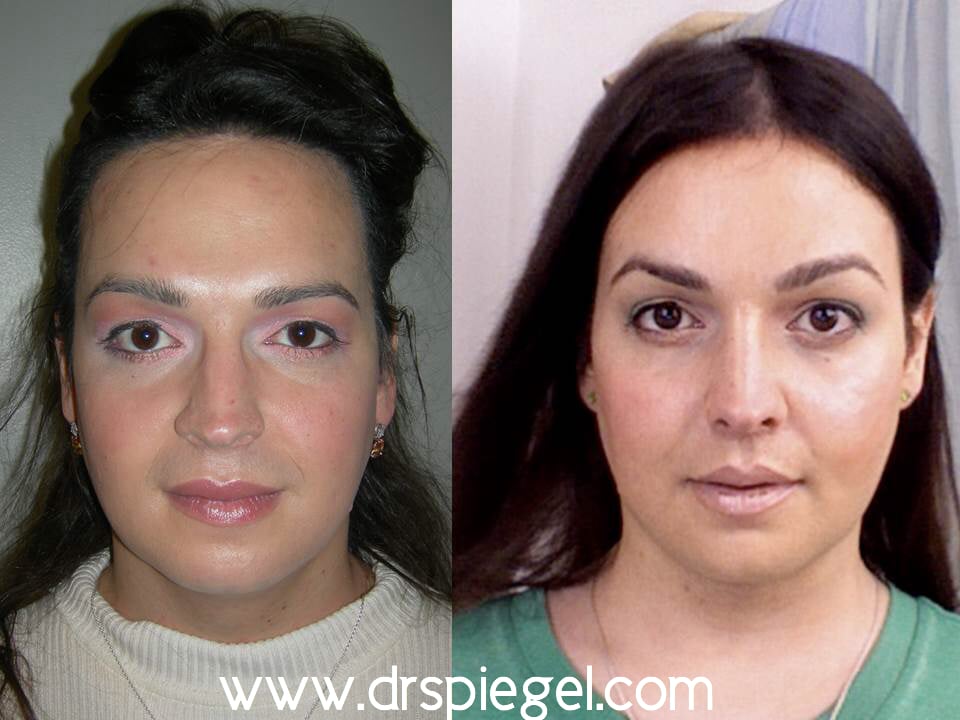 9. Sex Reassignment Surgery A transgender woman who is also - Transgender Surgeries Male-to ...