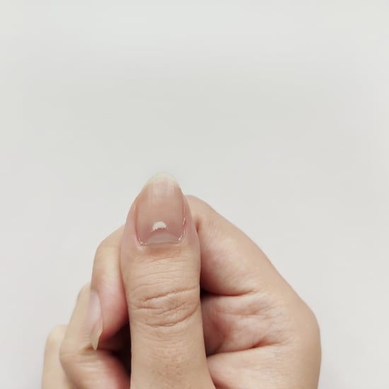 Nails With White Spots: Causes and How to Treat