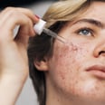 How to Treat Pimples Under the Skin That Won't Go Away