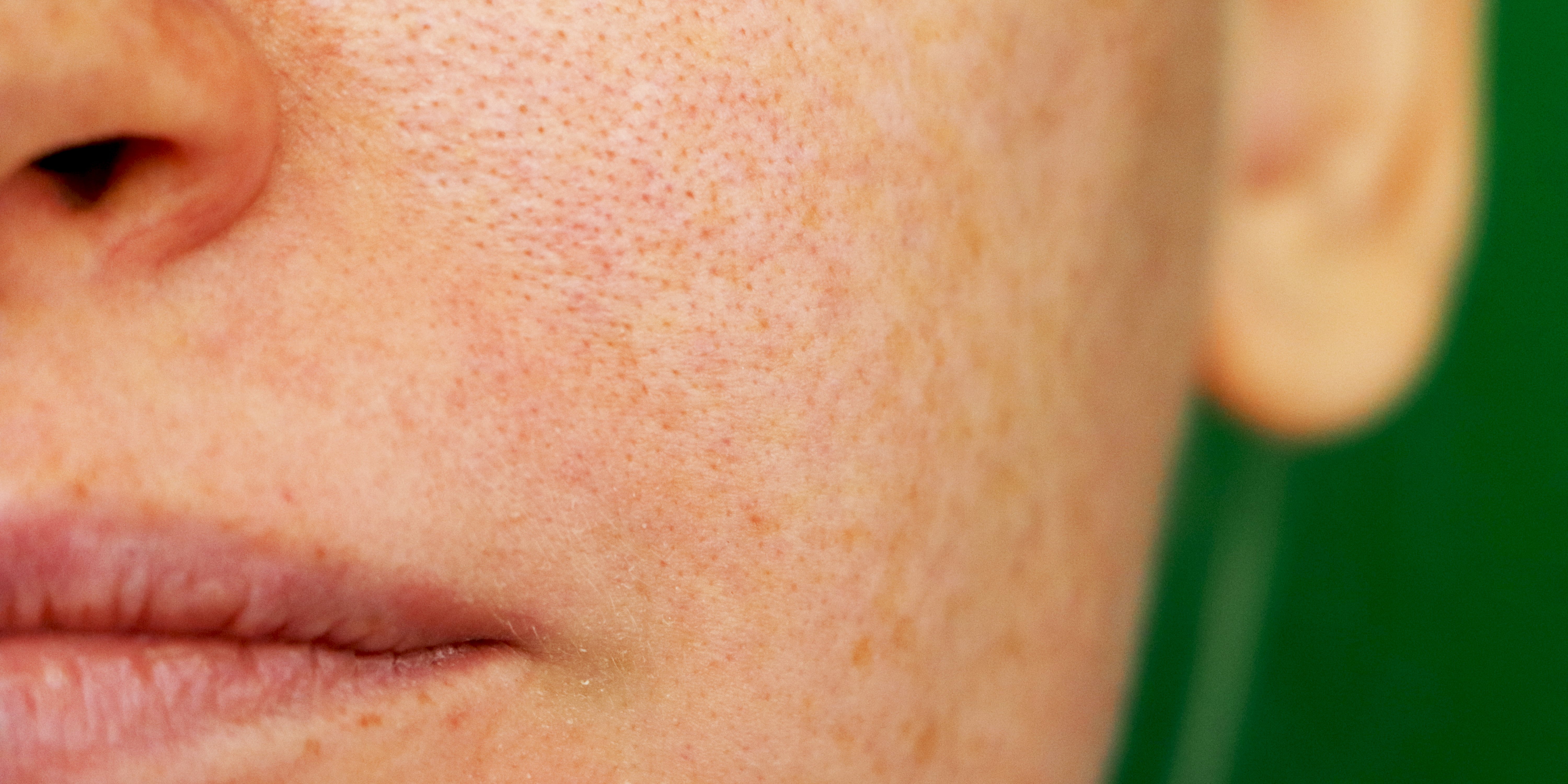 Melasma Treatment and Causes From Doctors - Vimarsana News