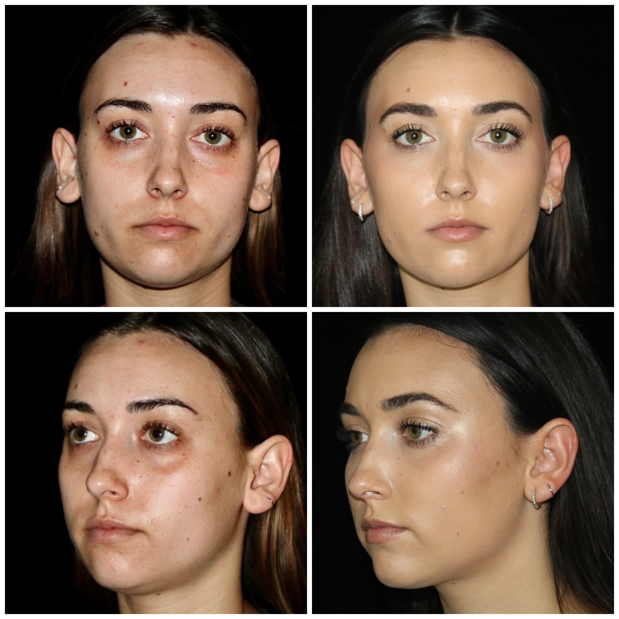 Under Eye Fat Grafting with Nanofat by Dr. Steven Cohen