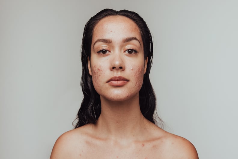 what is cortisol face?