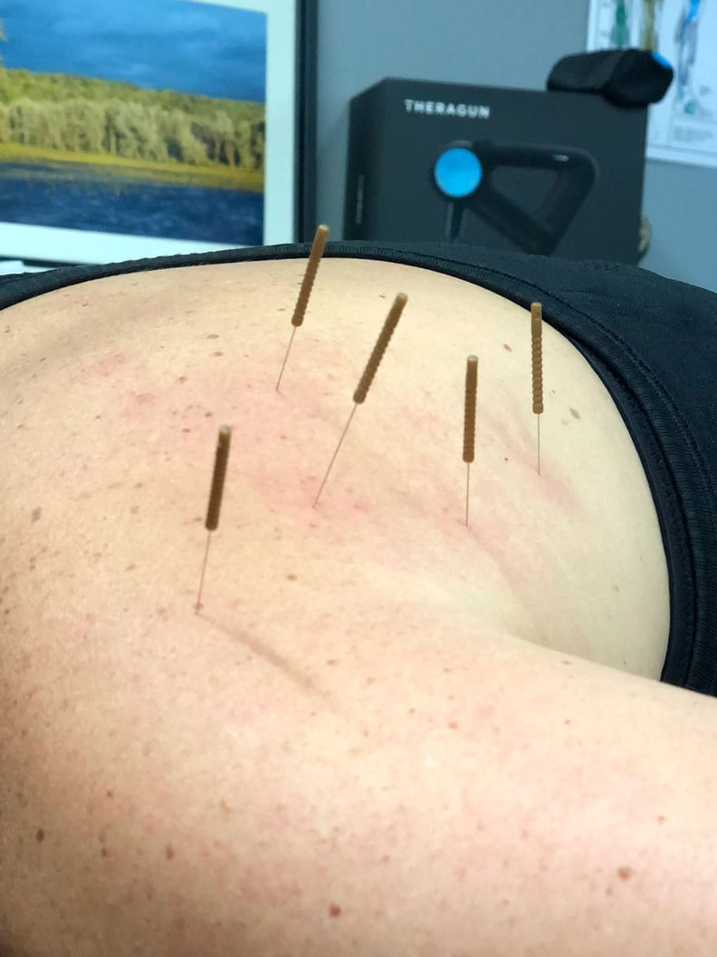 What Does It Feel Like After You Get Dry Needling?