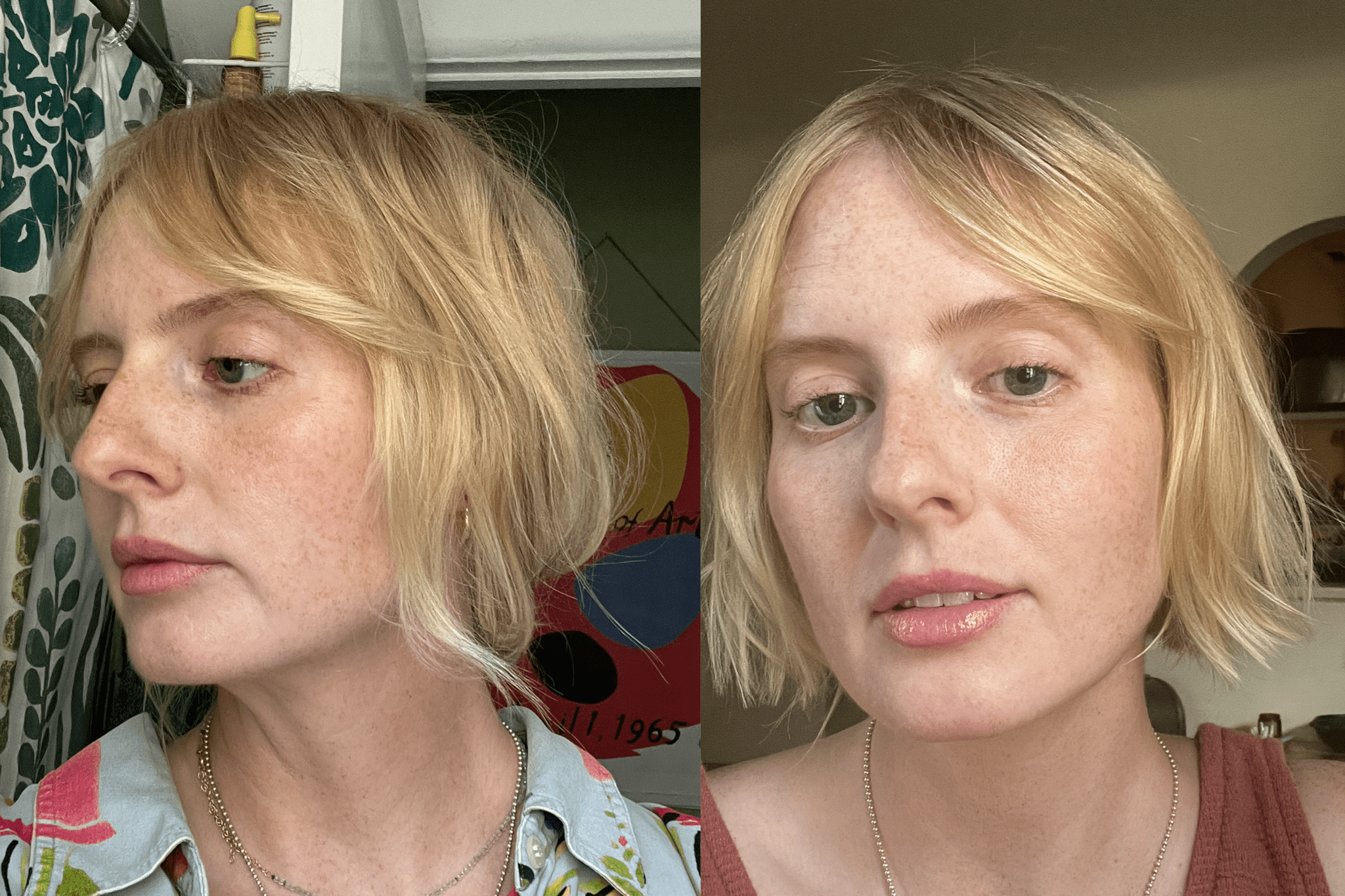 Before and after Ellacore micro-coring skin tightening treatment