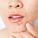 PCOS and Acne: Dermatologists Explain Causes and Treatments