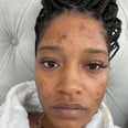 Keke Palmer's Latest Selfie Comes With a Message About Acne and PCOS: "You're Not Alone"