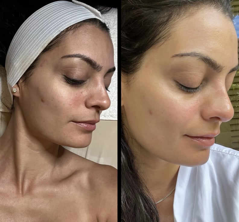 Before and after $500 non-surgical lift facial
