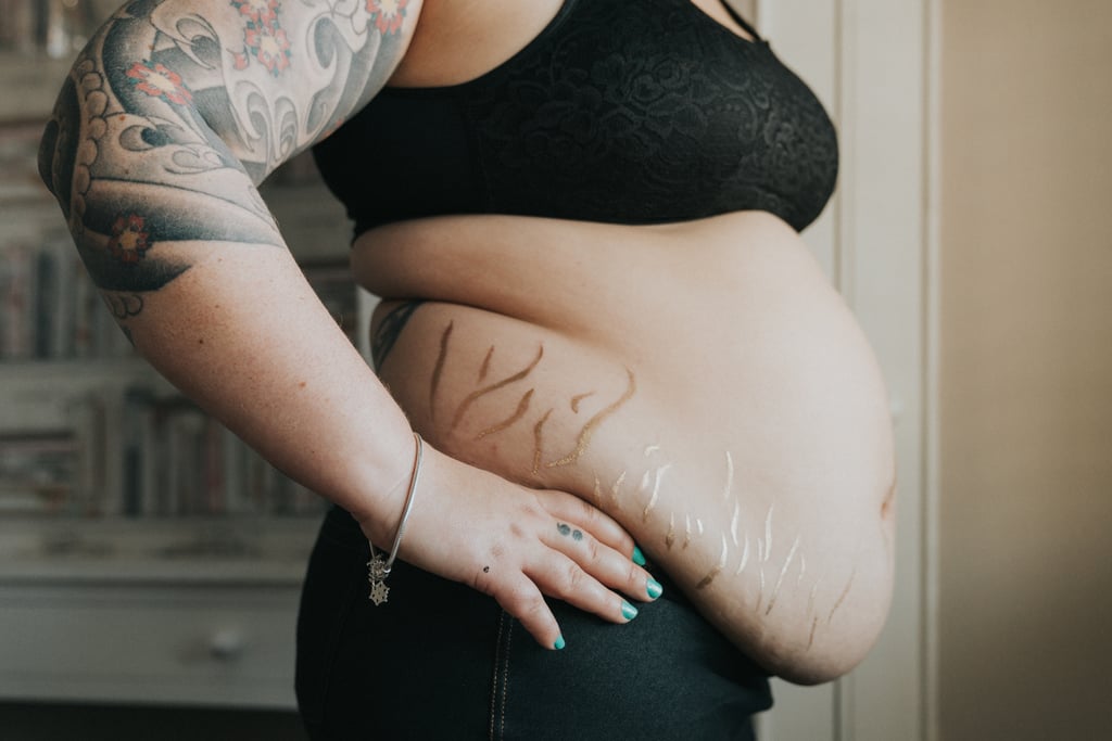 Postpartum Stretch Marks Photos