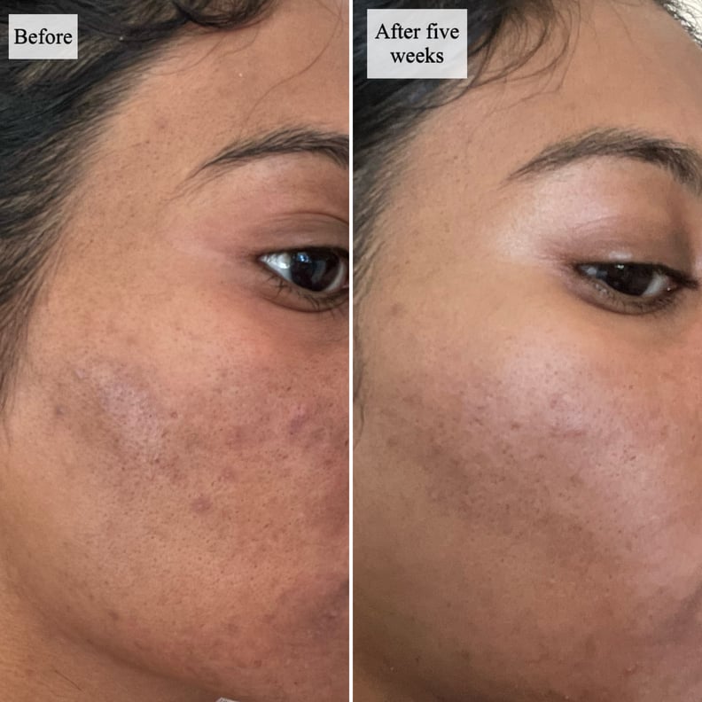 Before and after skin results using the Dr. Idriss Major Fade Hyper Serum for five weeks.