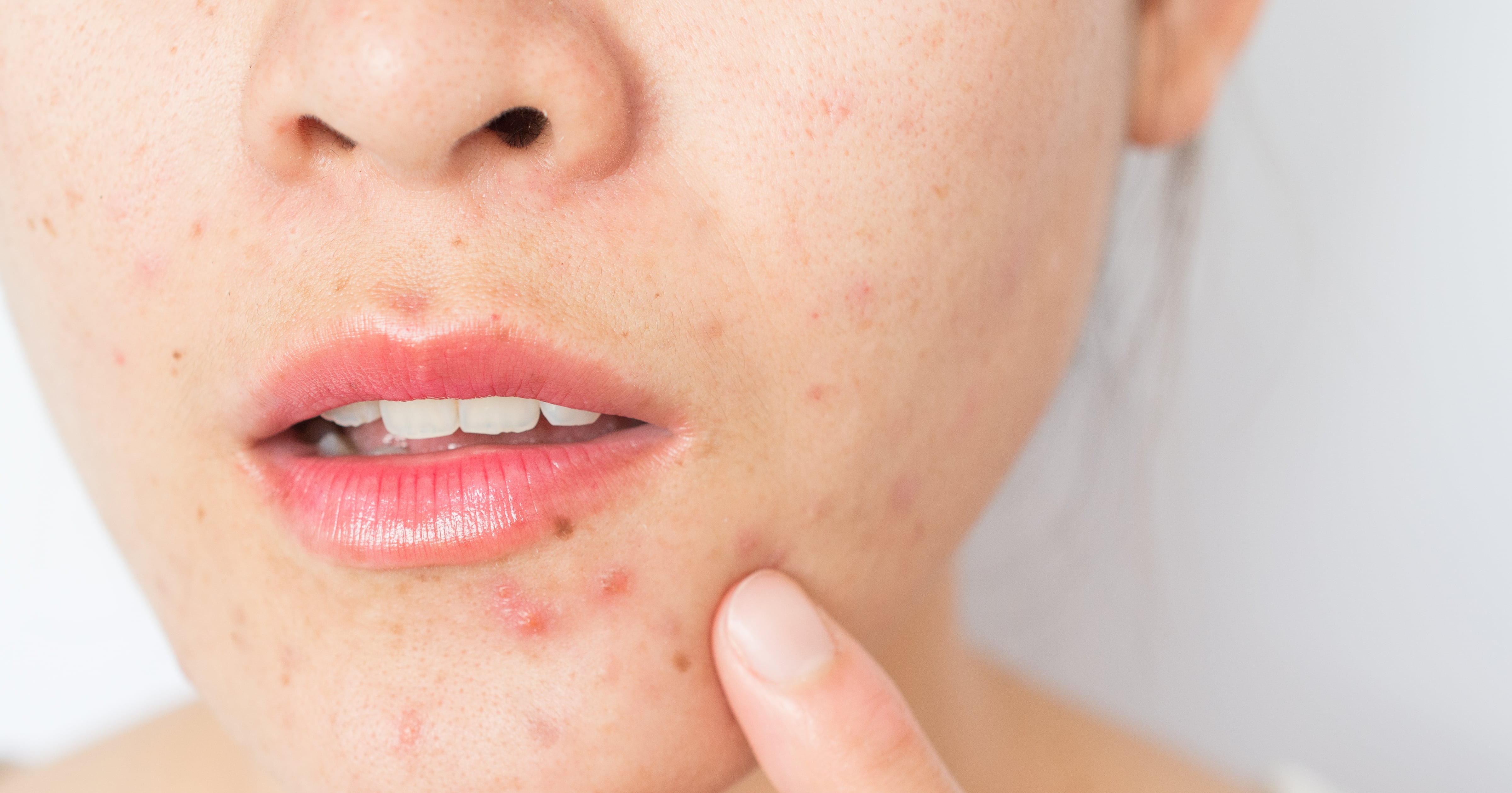 PCOS and Acne: Dermatologists Explain Causes and Treatments | PS Beauty