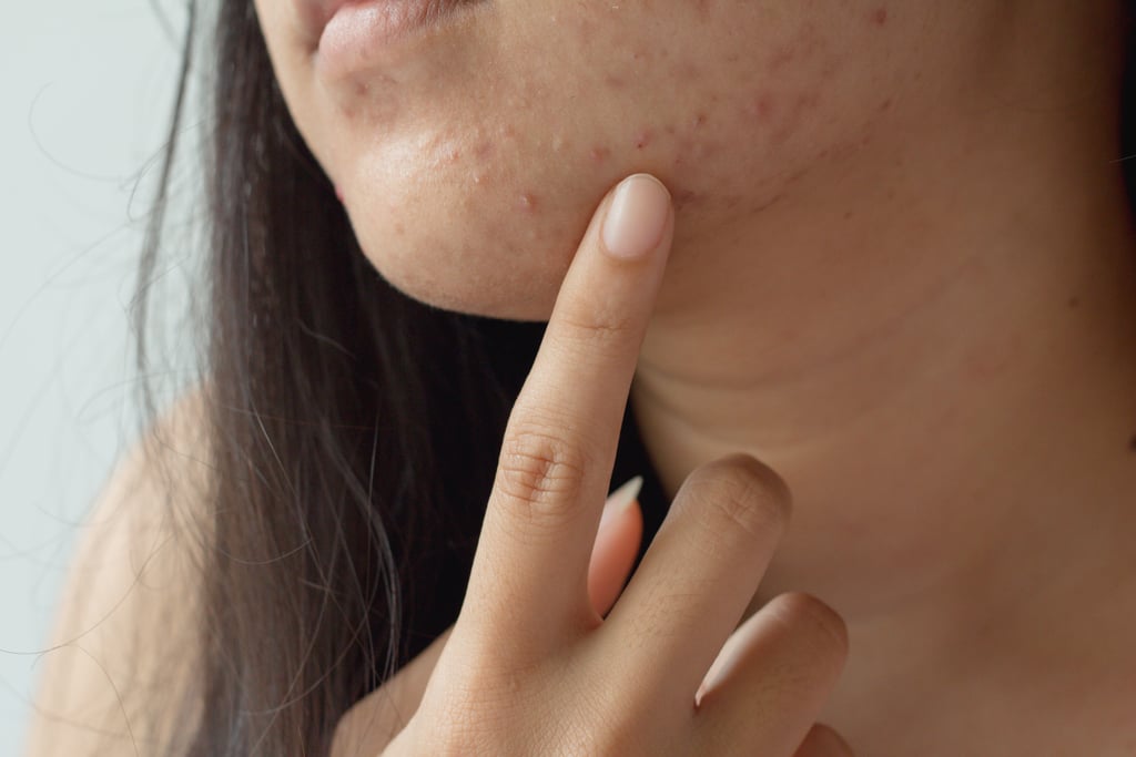 How Do You Treat Pimples and Ingrown Hairs?