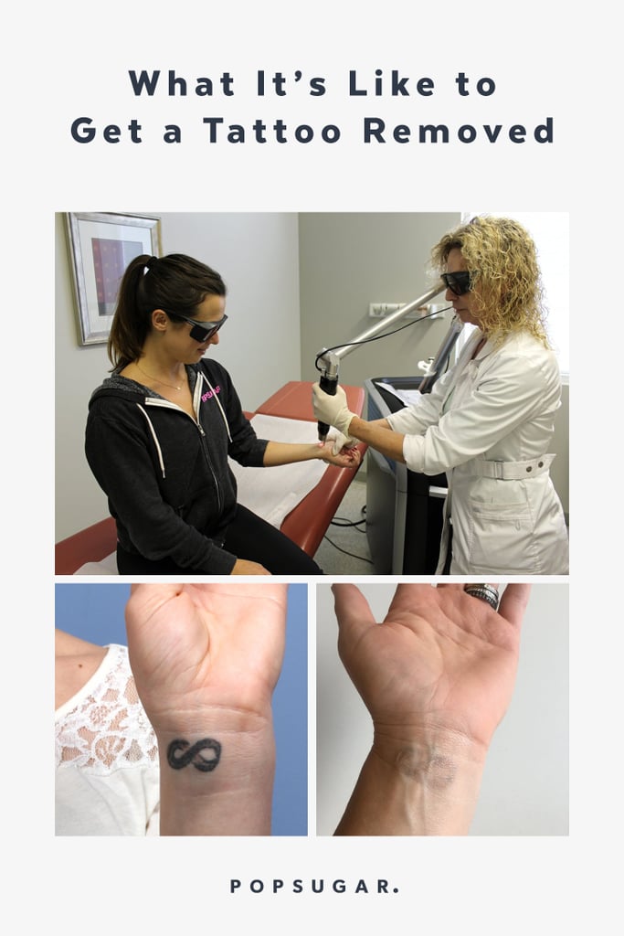 What It's Like to Have a Tattoo Removed