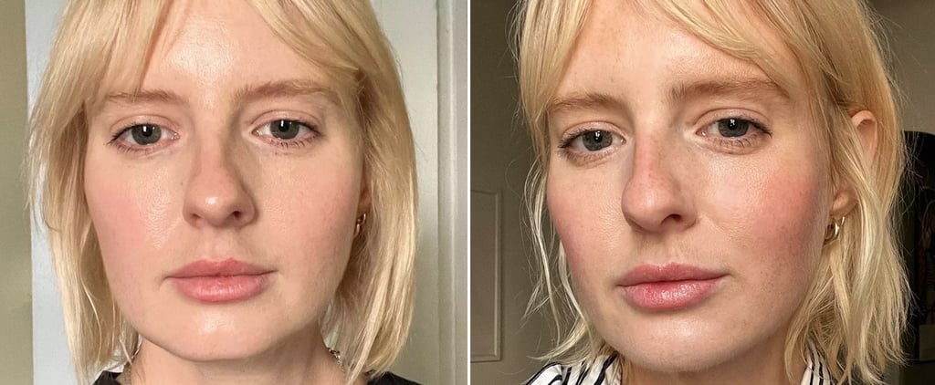 I Got Chin Filler For a Sharper Jawline, and My Results Speak For Themselves