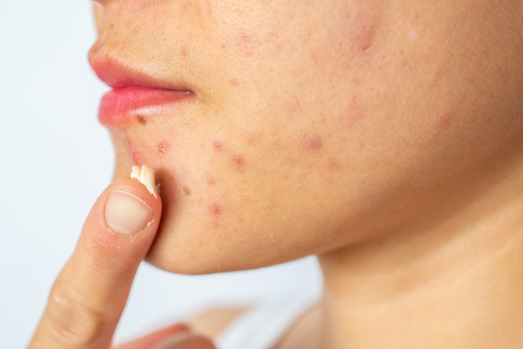 Acne Causes: Improper Treatment