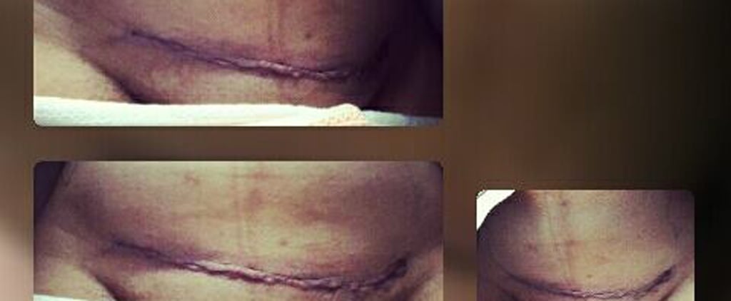 Why This Mom Doesn't Think C-Sections Are the Easy Way Out