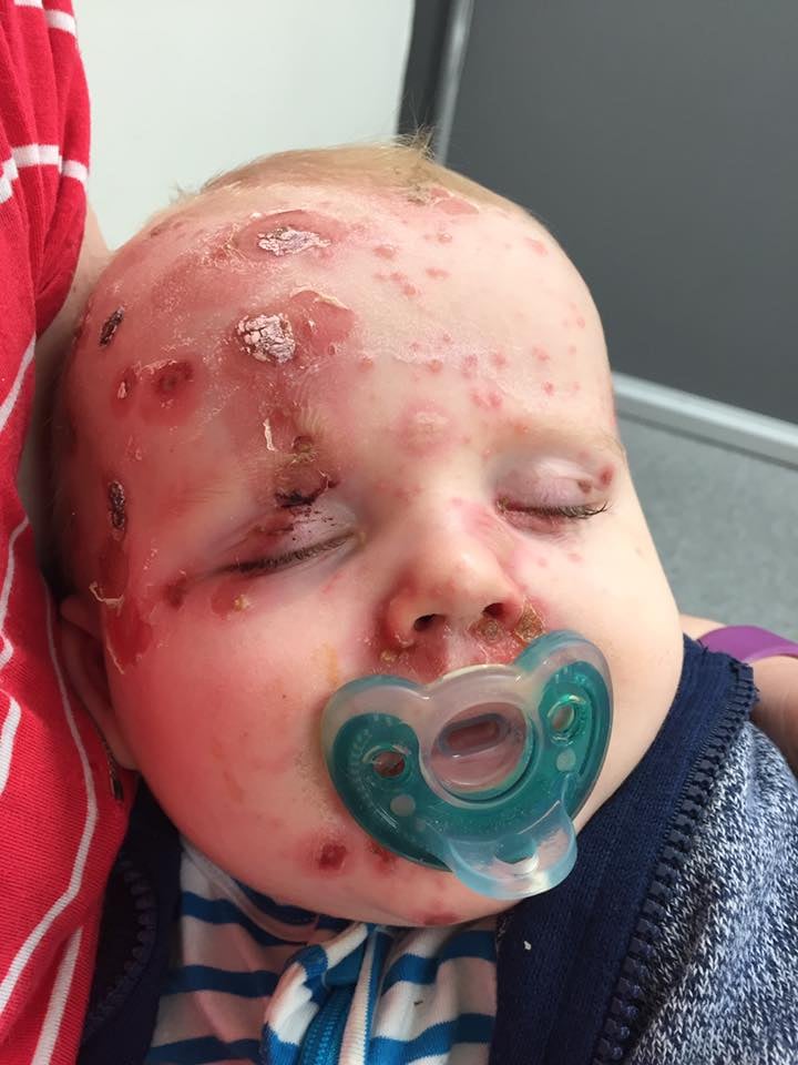 Mom's Plea to Anti-Vaxxers After Baby Gets Chicken Pox