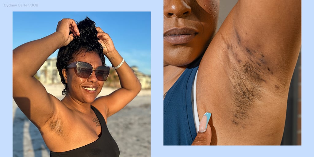 How I Learned to Love My Bumps and Scars From Hidradenitis Suppurativa