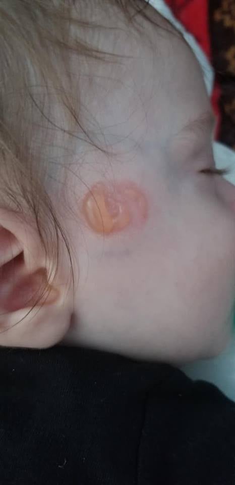 Mom's Warning on Pacifiers After Son Gets Burned