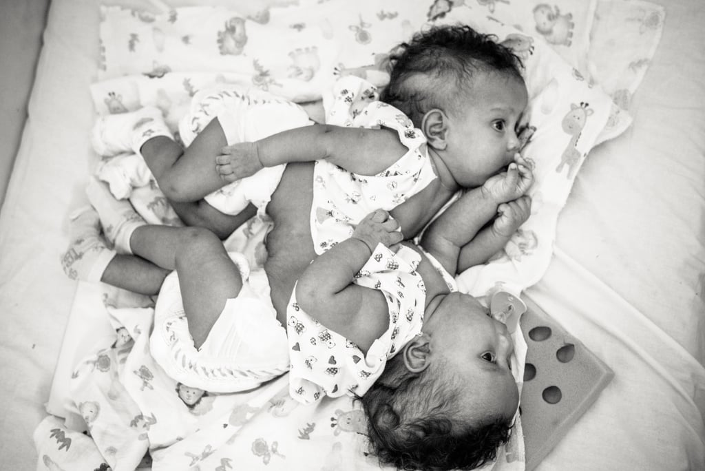 Photographer Captures the Beauty of Conjoined Twins