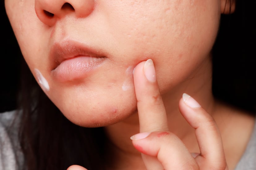 Benzoyl peroxide for acne can be an effective treatment