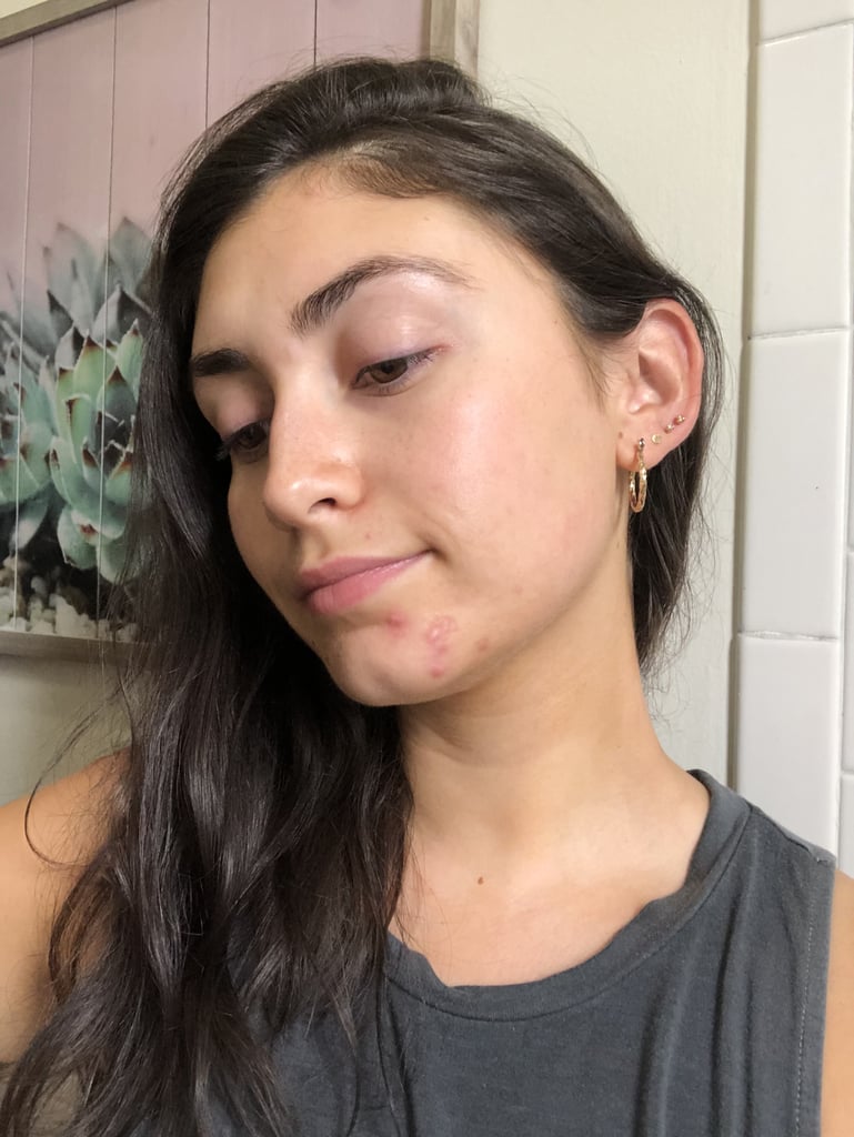 2 Weeks After Using the Dr. Dennis Gross Blemish Solutions Acne Eliminating Gel