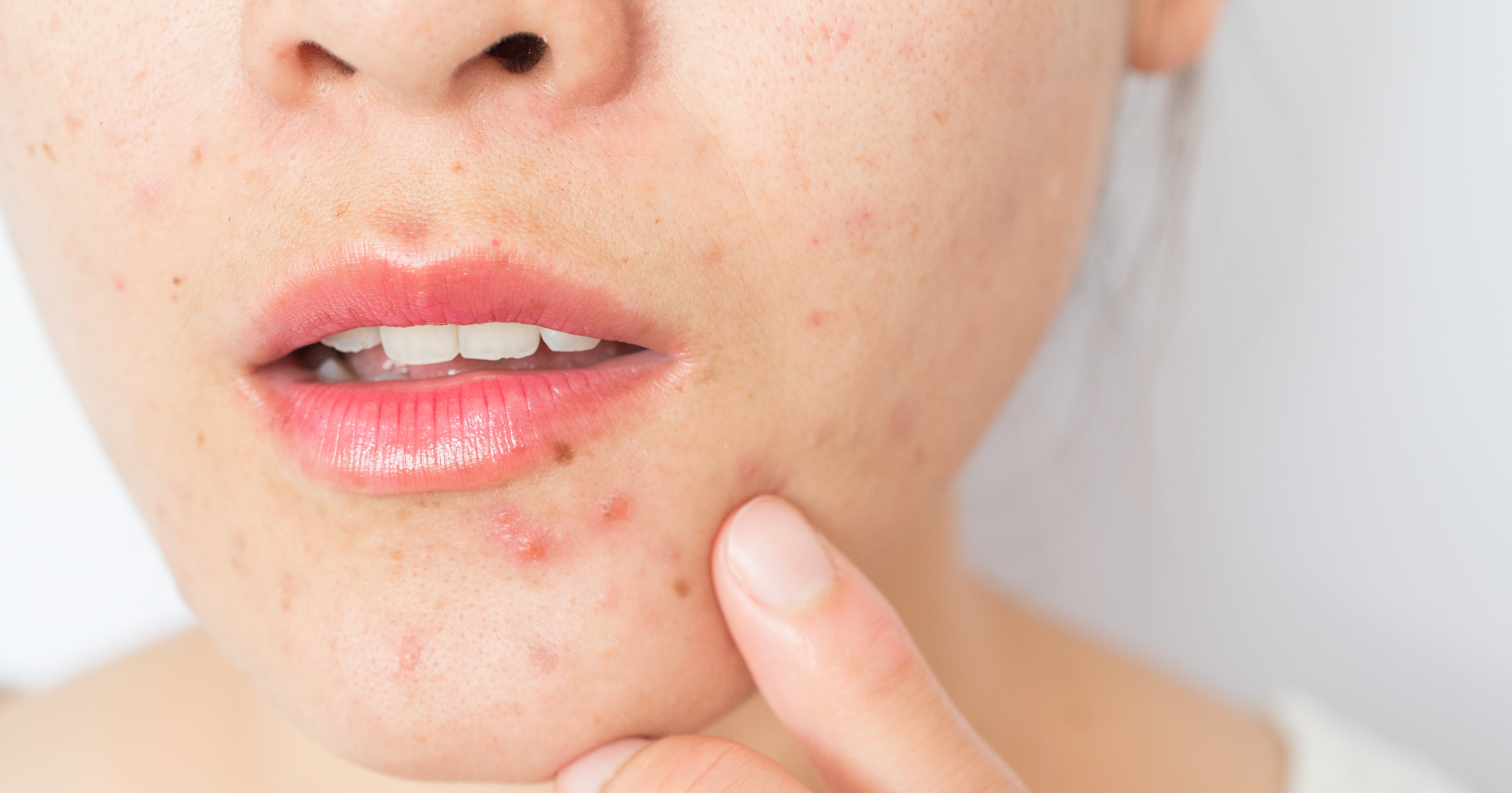 What Is Perioral Dermatitis? 2 Dermatologists Explain