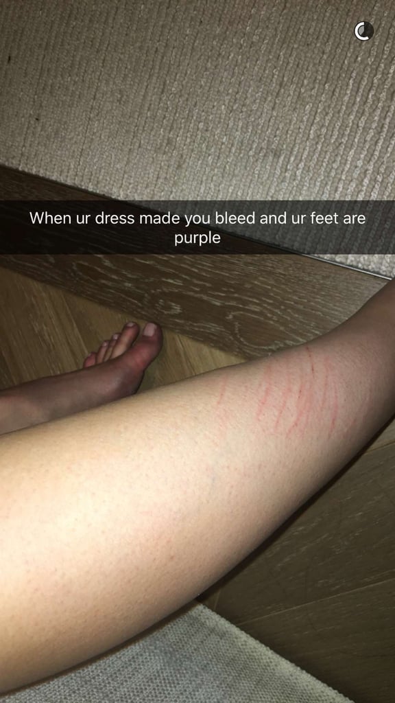 Kylie's Met Gala Dress Gave Her Scratches
