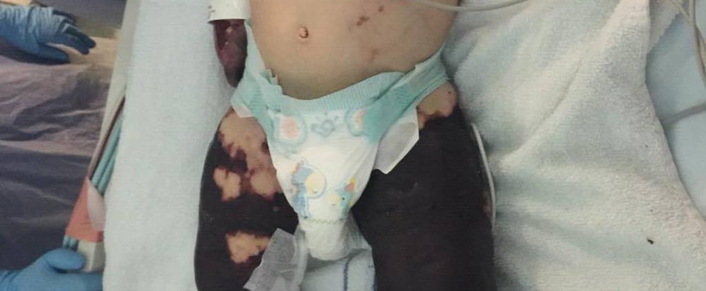 Boy With Amputations From Meningitis Takes First Steps