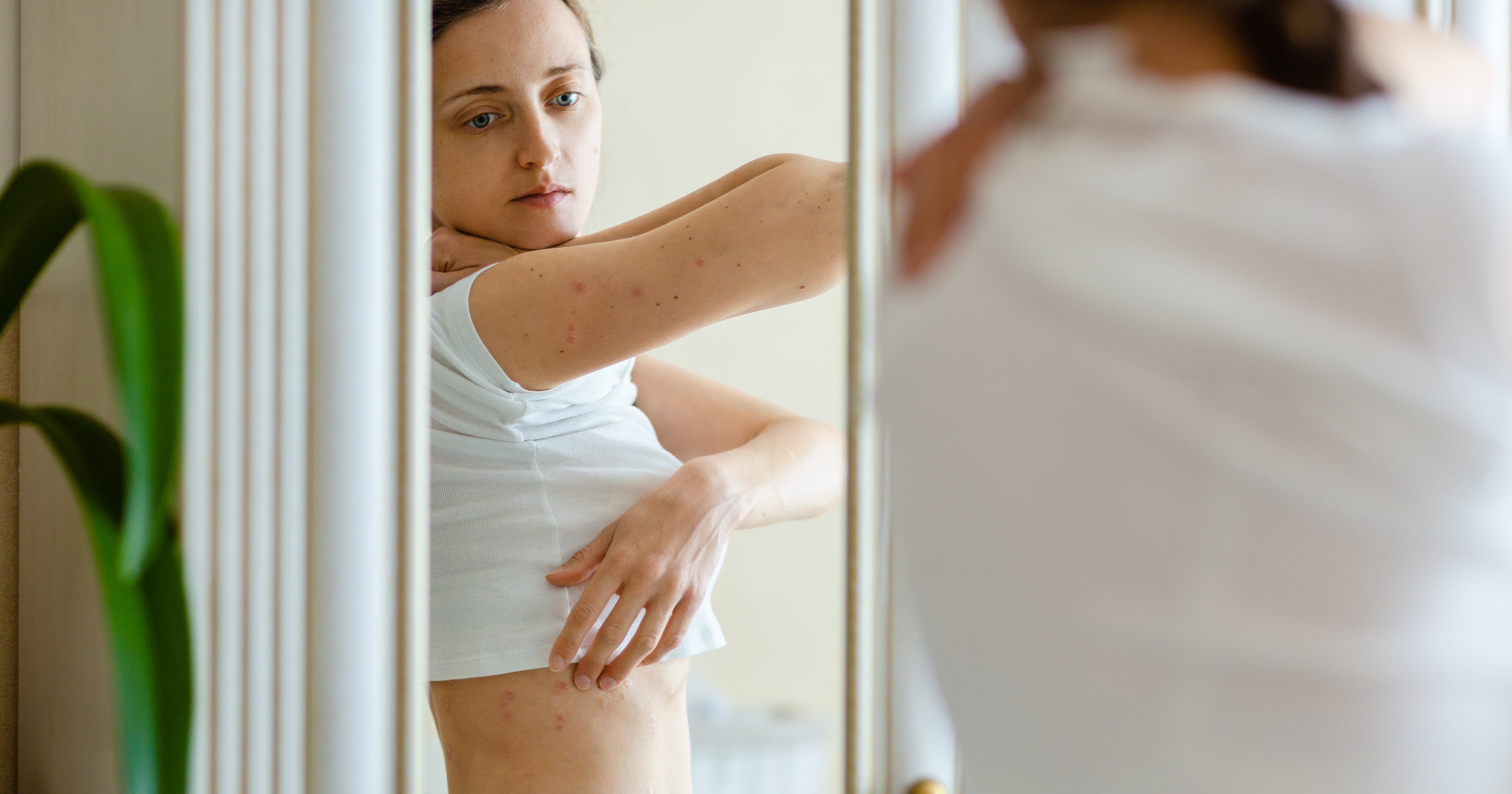 Suffering From Eczema? Here’s What You Need to Know